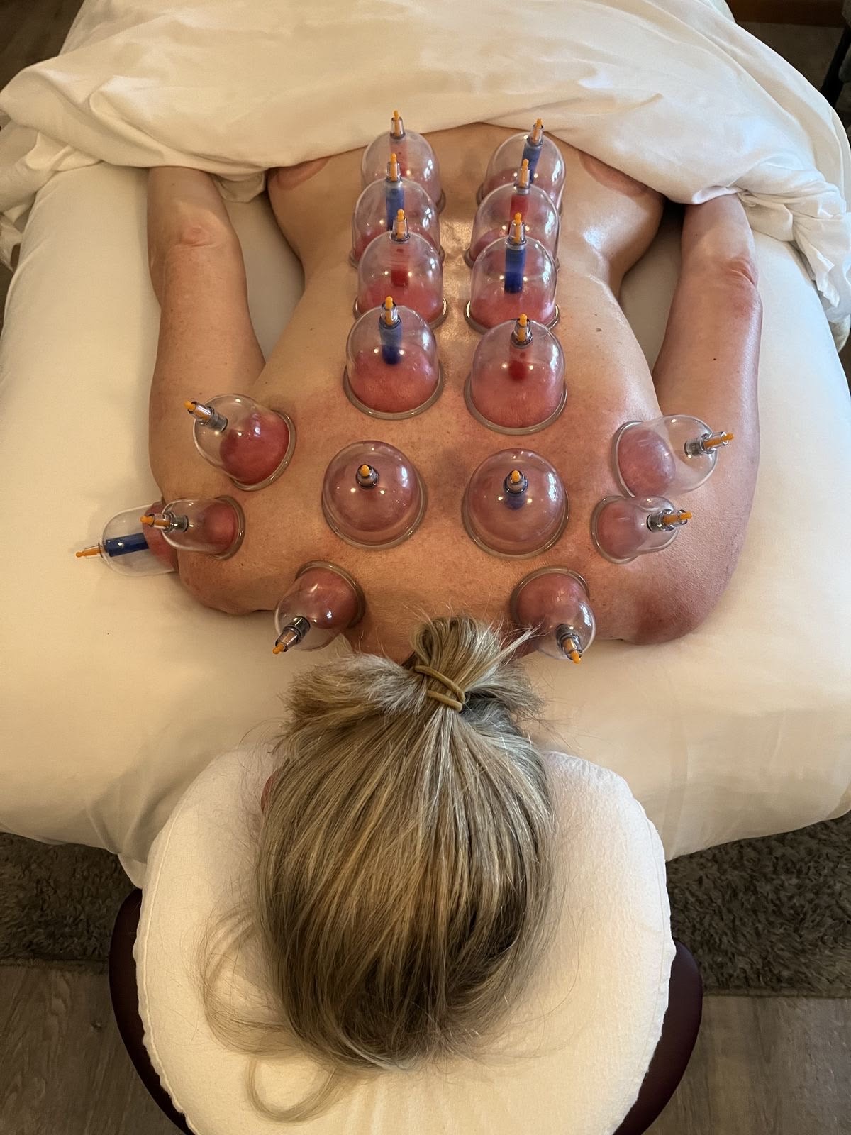 Guest receiving Cupping Therapy at Nami Thai Massage & Spa